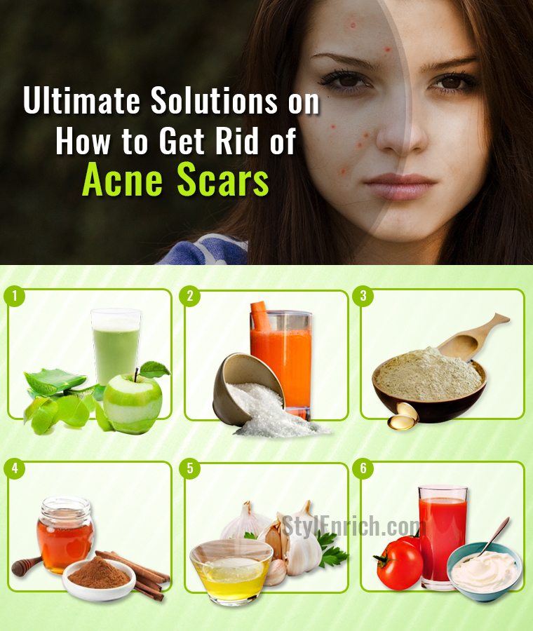 How to Get Rid of Acne Scars With Top 10 Ultimate Solutions?