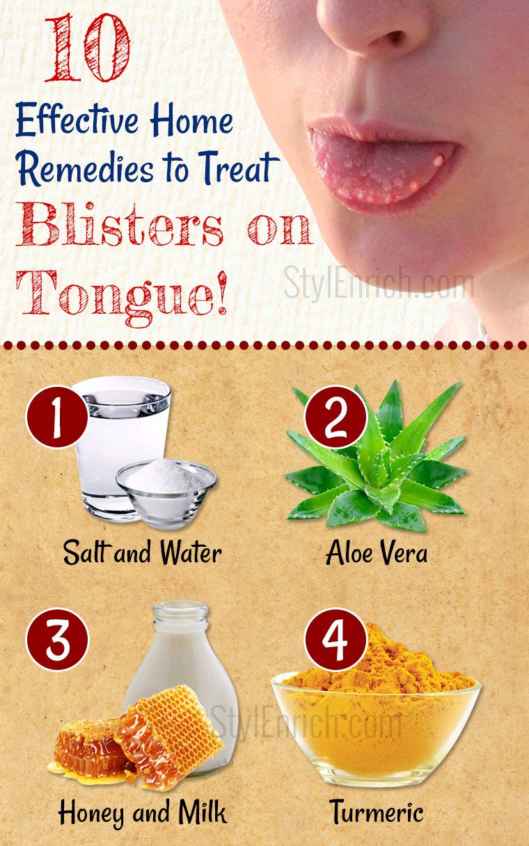 home-remedies-for-blisters-on-tongue-how-to-treat-tongue-blisters