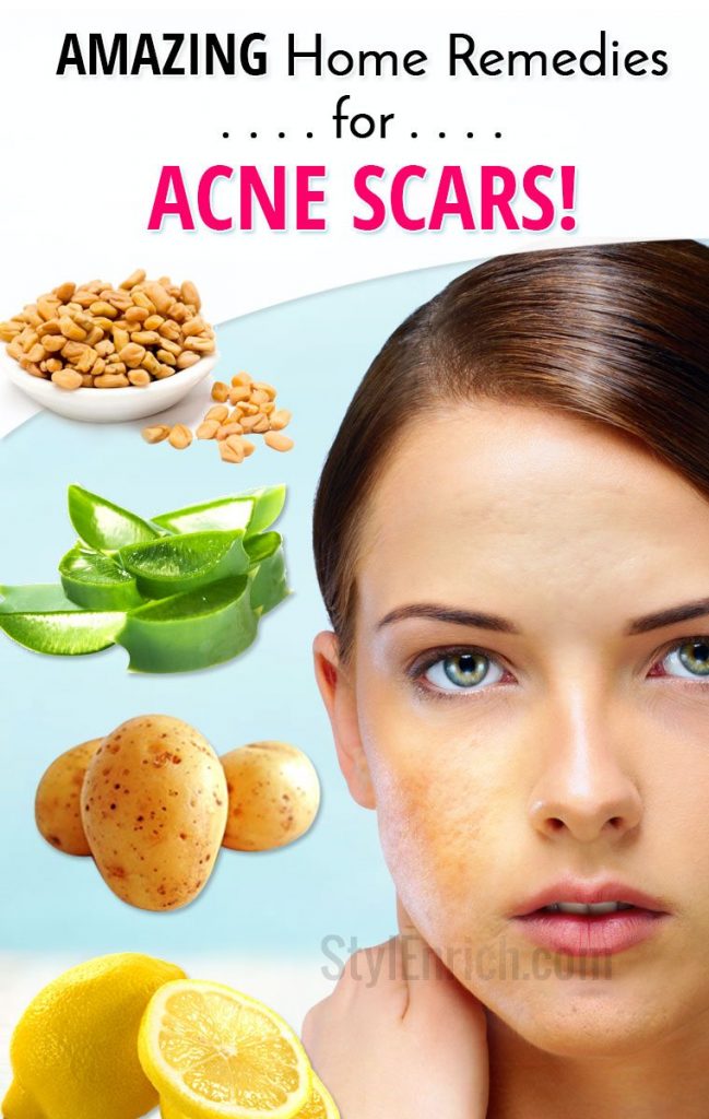 Acne Scars Removal At Home With Baking Soda Reference: Home Remedies For Acne Scars