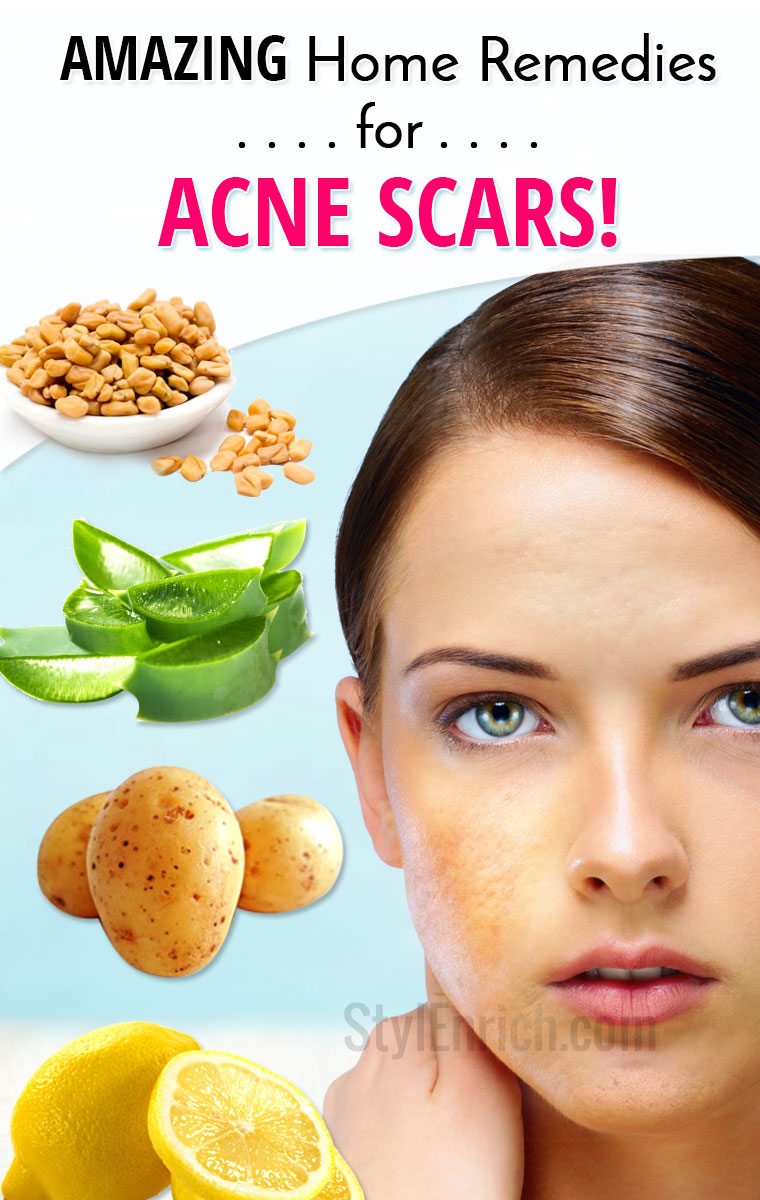 Home remedies for acne scars