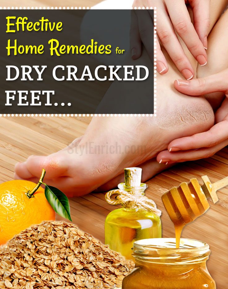 Home Remedies for Dry Cracked Feet