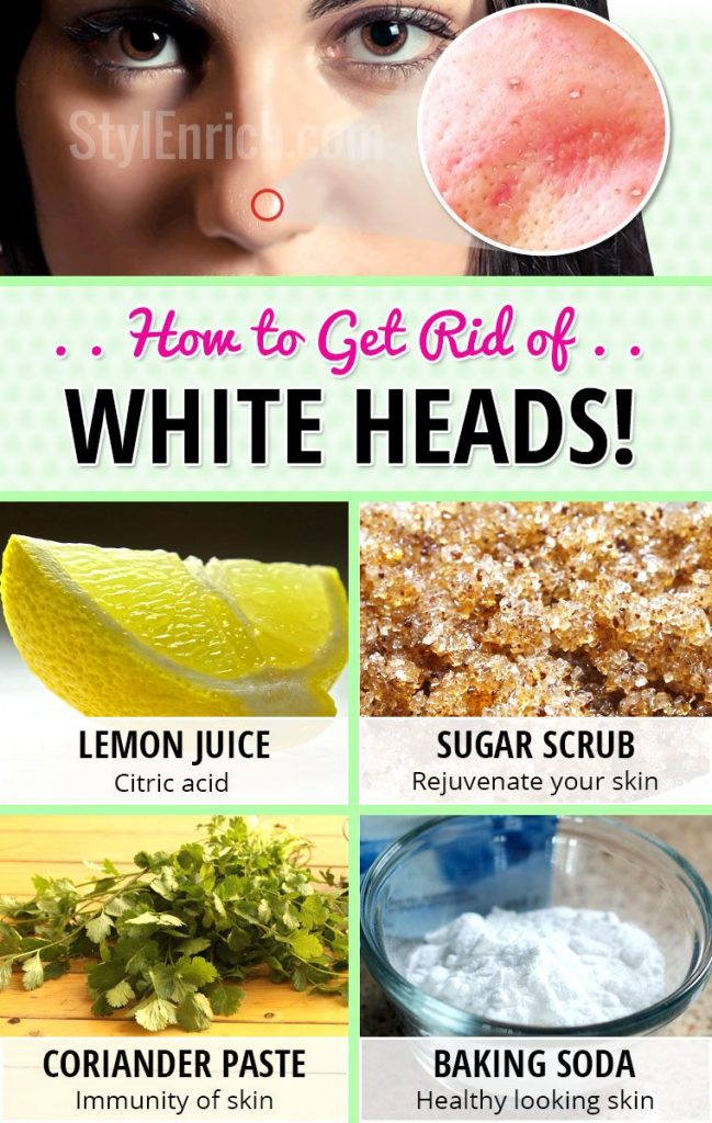 How To Get Rid Of Whiteheads On Face Using Home Remedies?