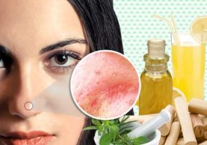 How to Get Rid of Whiteheads on Face!