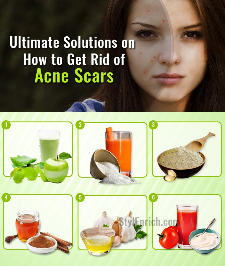 How to Get Rid of Acne Scars.