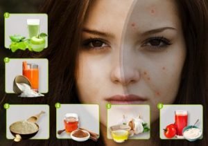 Ultimate Solutions on How to Get Rid of Acne Scars.