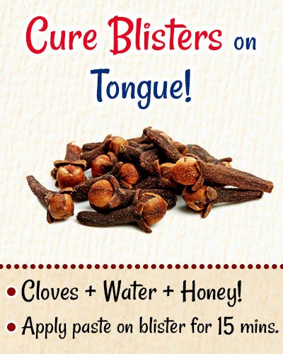 Cloves To Cure Blisters on Tongue