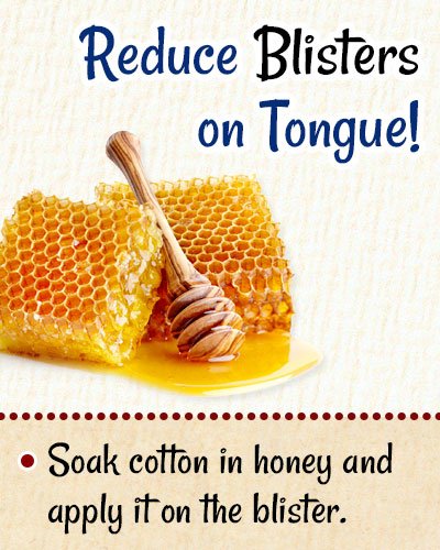 Honey to Reduce Blisters On Tongue