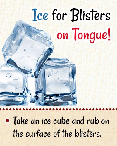 Ice For Blisters On Tongue