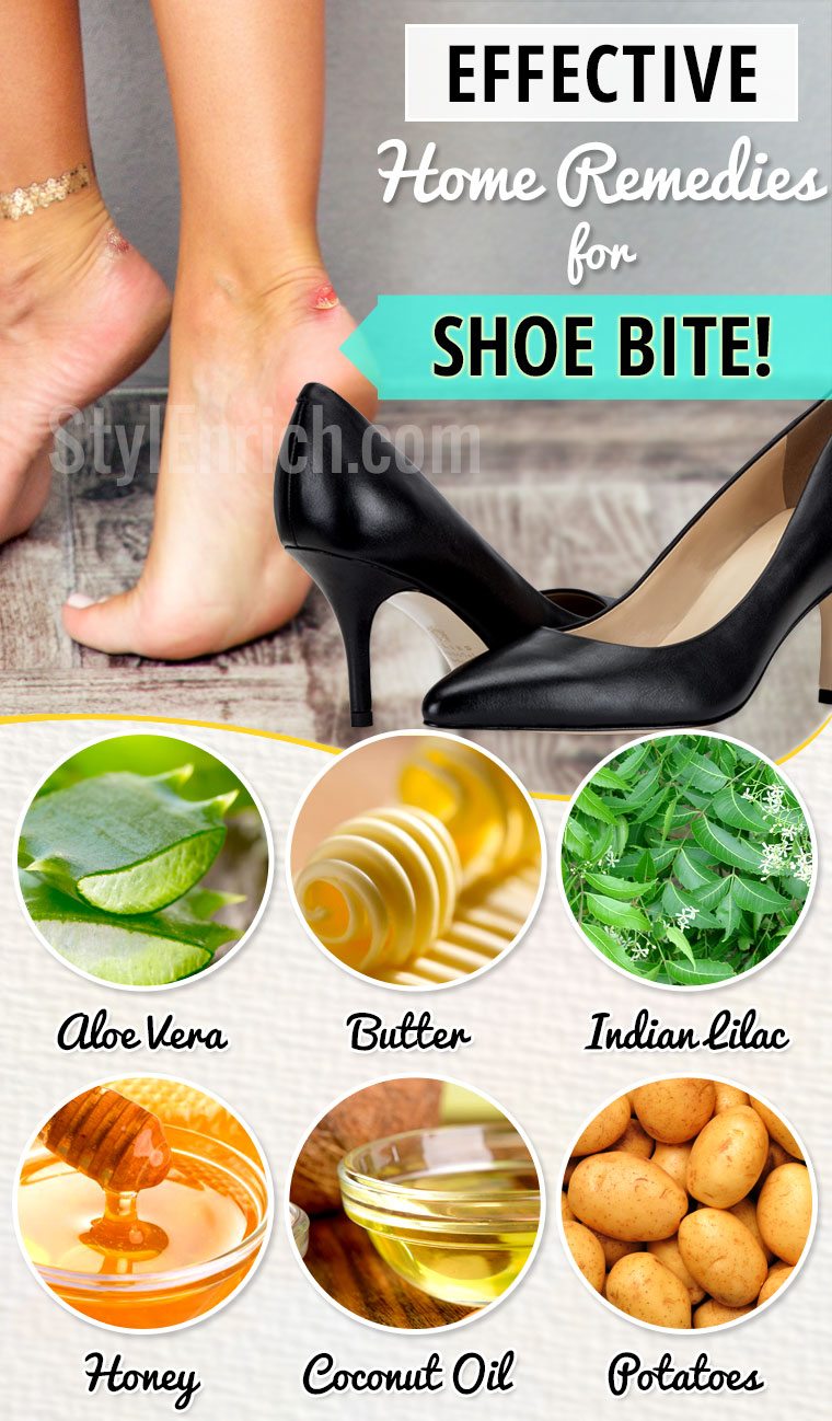 Home remedies for shoe bite