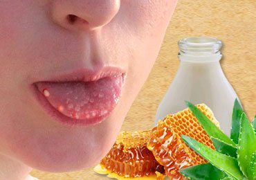 Home Remedies for Blisters on Tongue