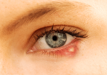 Home Remedies for Eye Sty