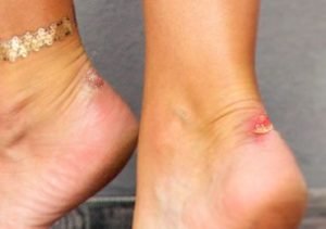 Home remedies for shoe bite