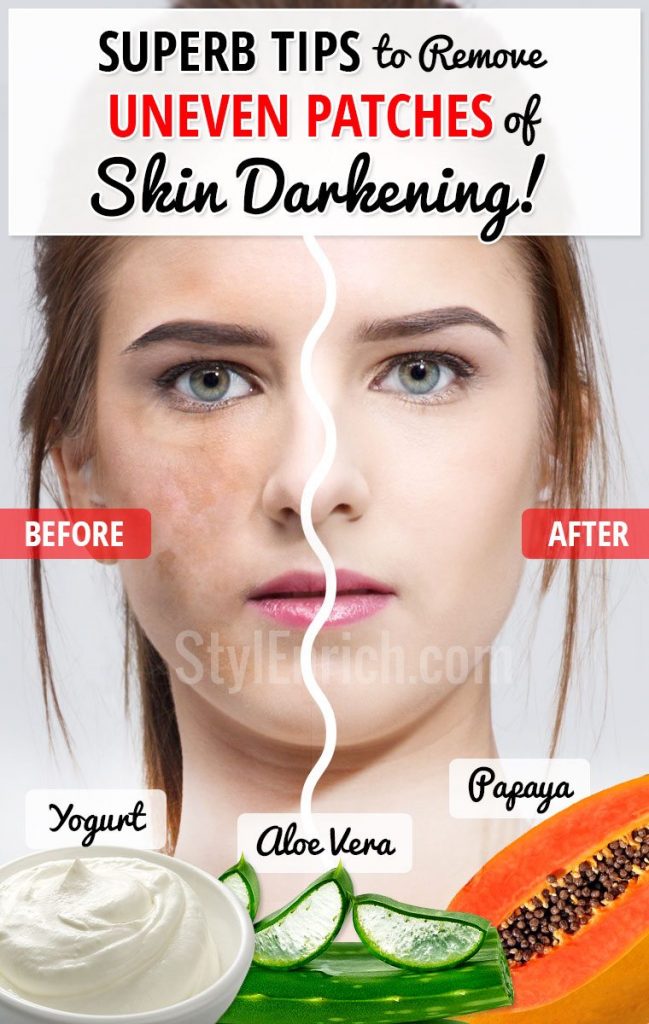 Skin Care Superb Tips To Remove Uneven Patches Of Skin Darkening