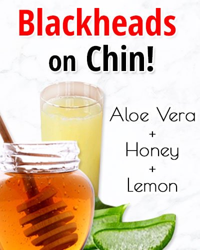 Aloe Vera Gel, Honey, and Lemon Juice for Blackheads On Chin