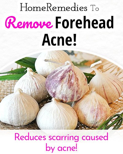 Garlic to Remove Forehead Acne