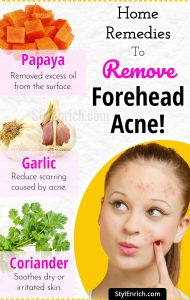 Forehead Acne : How To Get Rid Of Acne With Top 5 Home Remedies!