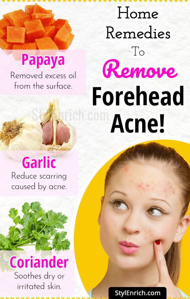 Forehead Acne : How To Get Rid of Acne With Top 5 Home Remedies!