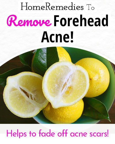 Lemon Juice to Remove Forehead Acne