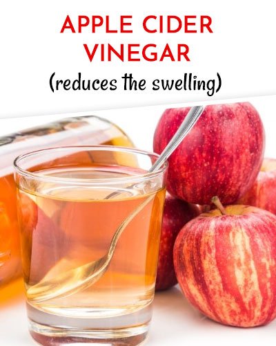 Apple Cider Vinegar to Get Rid of Varicose Veins