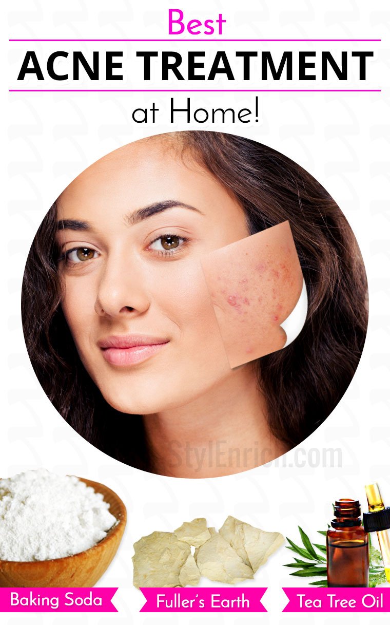 Best acne treatment at home