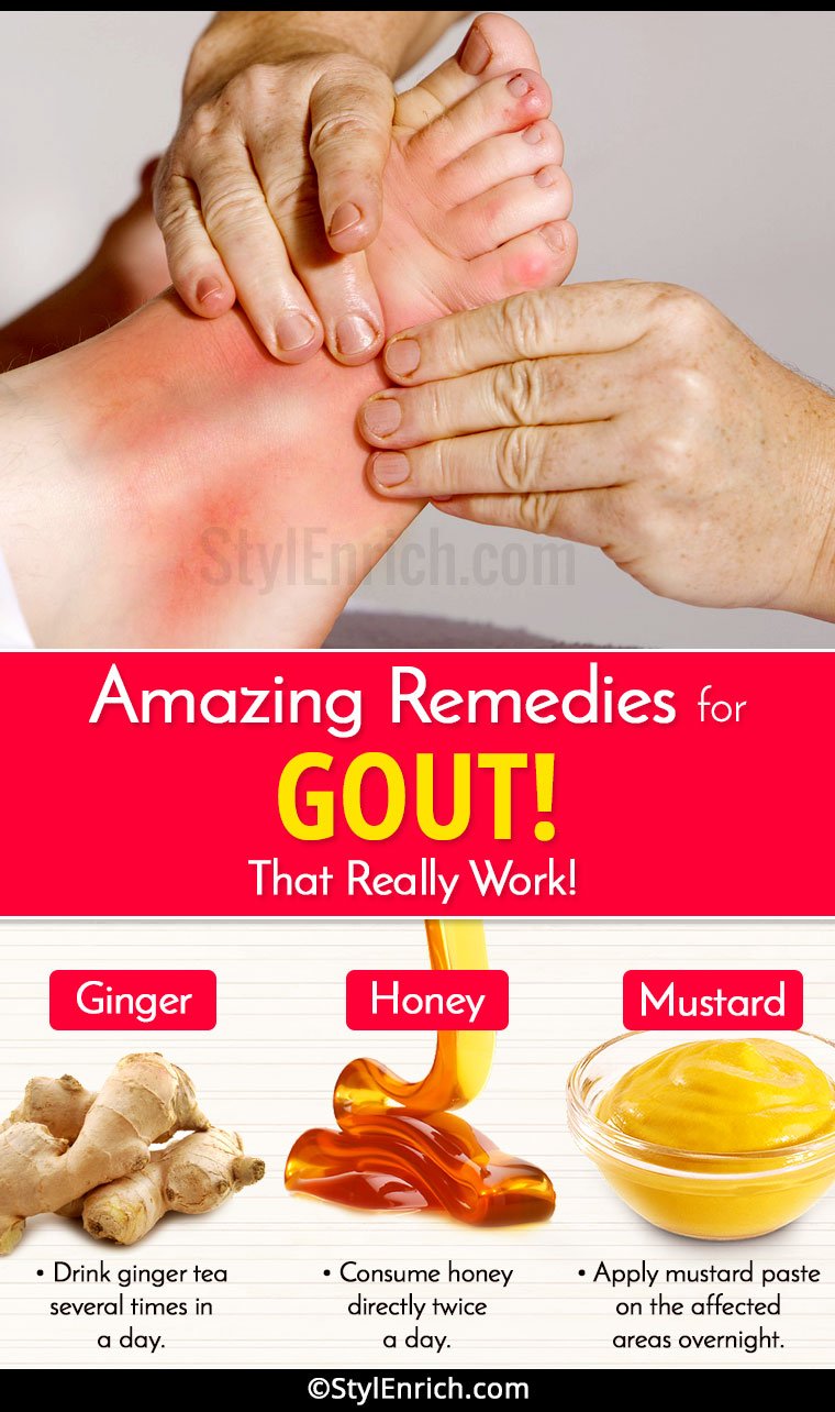 Home Remedies for Gout