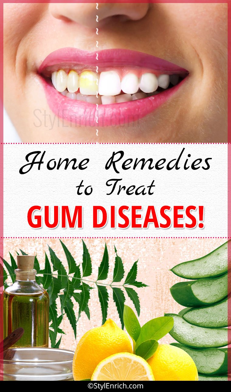 Home Remedies For Gum Disease