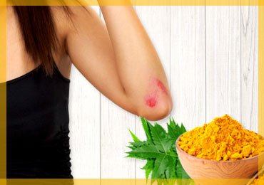Home Remedies for Minor Cuts and Grazes