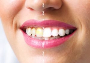 Home Remedies To Treat Gum Diseases