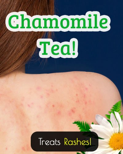 Chamomile Tea Treatment For Rashes And Allergies