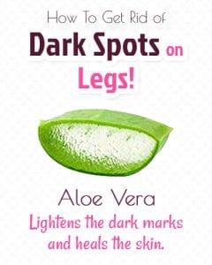 How to Get Rid of Dark Spots on Legs with Easy Natural Organic Recipes!