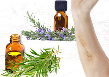 Very Effective Essential Oils for Scars!