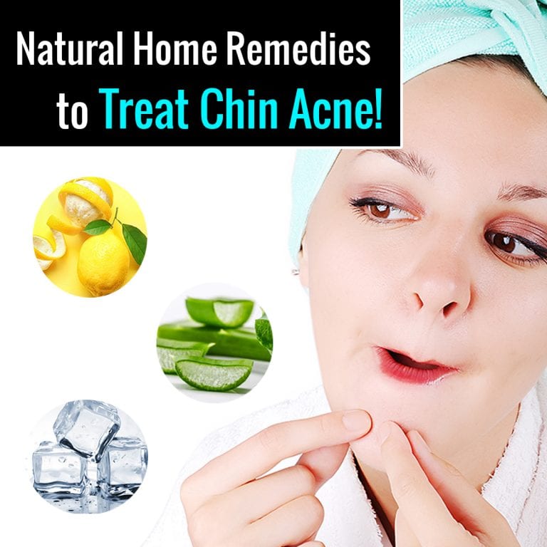 chin-acne-remedies