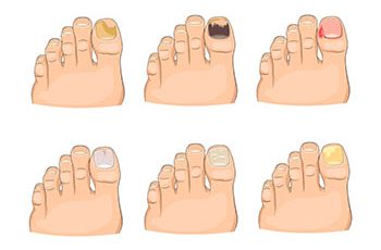 Toenail fungus infections
